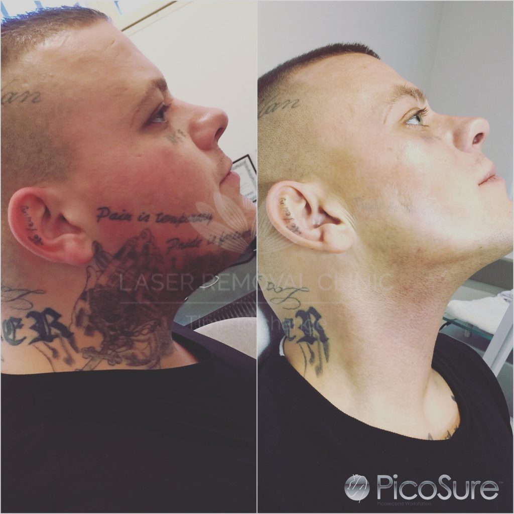 Fjern din tatovering med PicoSure laser
